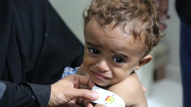Photo of ‘Hunger crippling a generation in Yemen’